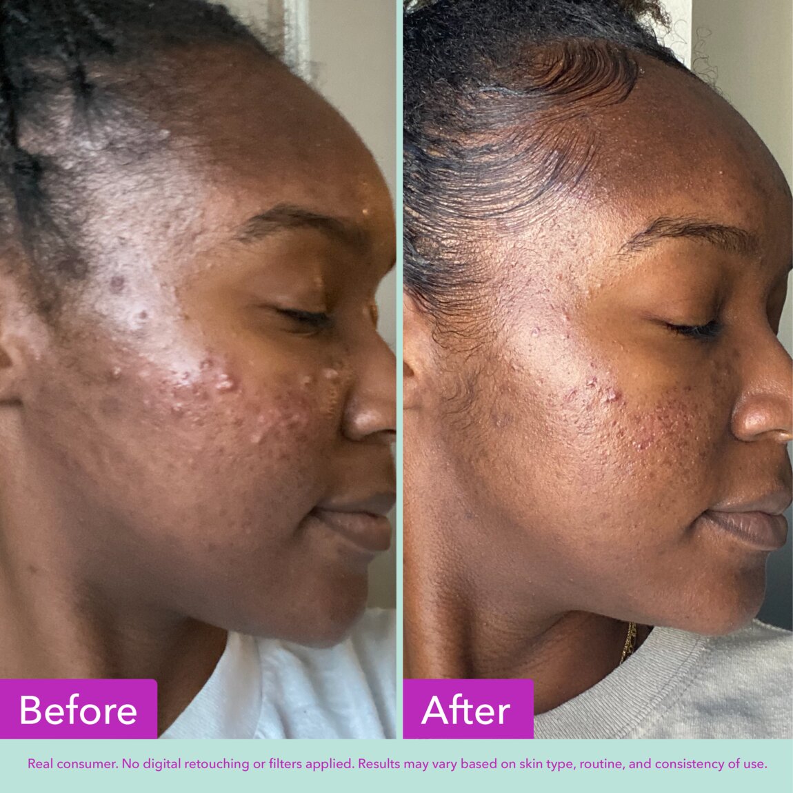 acne-foaming-cleanser-x0 zb_p.jpg
